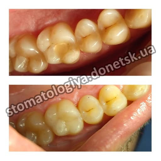 стоматология Донецк фотополимерная пломба цена